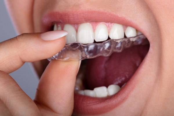 Fase de retención en la ortodoncia