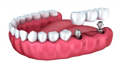 Implantología oral (II): “Un implante dental requiere los mismos cuidados que un diente natural”