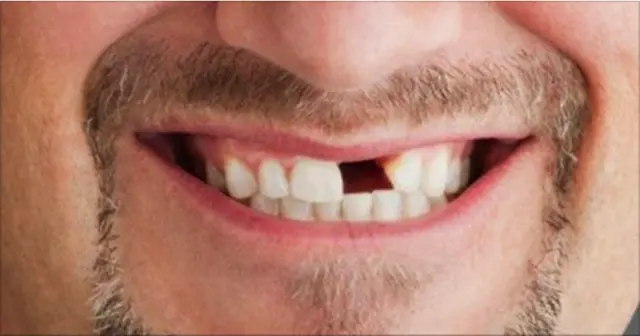 Qué hacer al perder un diente por traumatismo