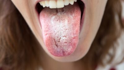 Hongos en la boca: causas, síntomas y tratamiento