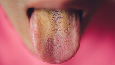 Causas de la lengua amarilla