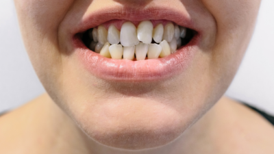 Apiñamiento dental: ¿qué es y cómo solucionarlo?