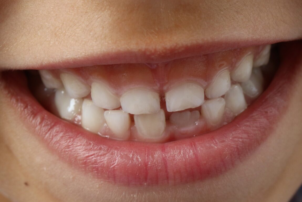 teeth-ge0a17001d_1920.jpg