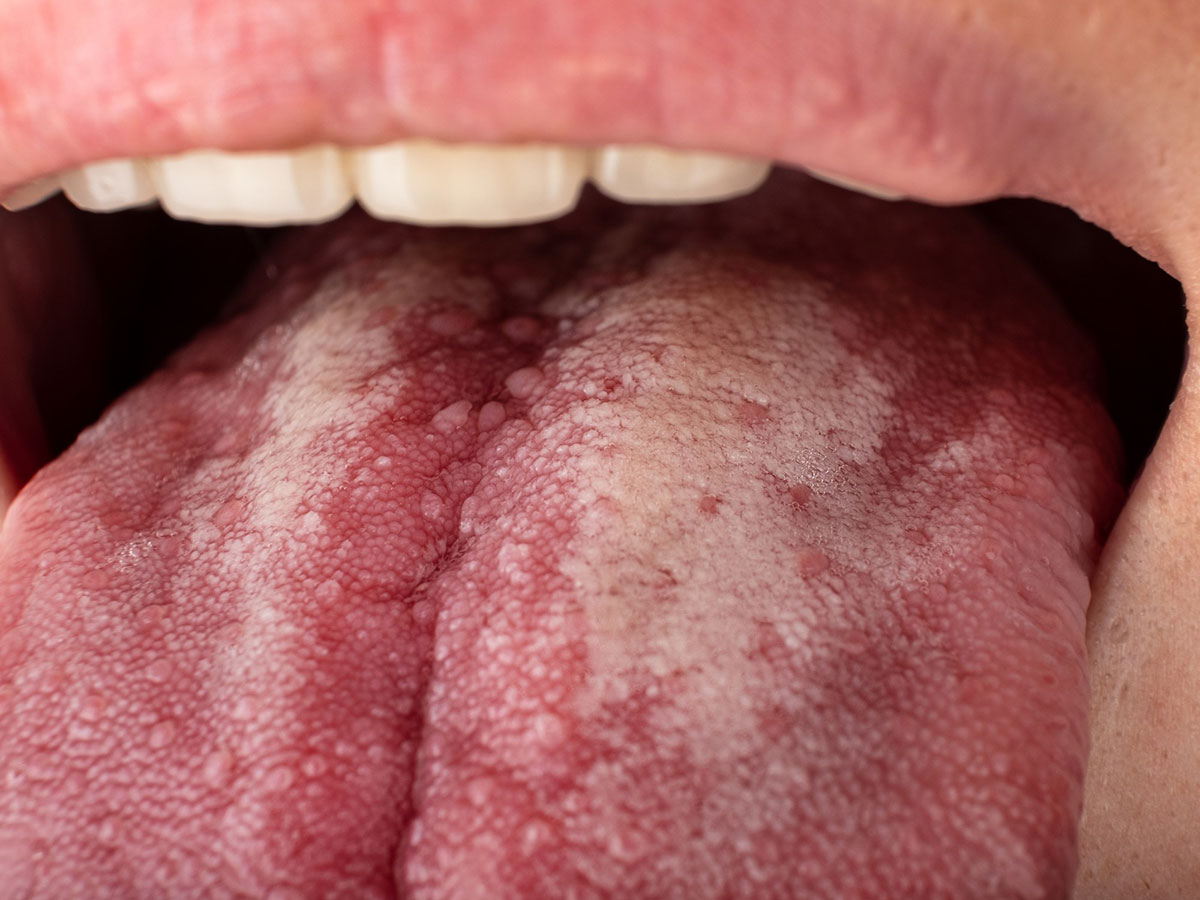 manchas en la lengua