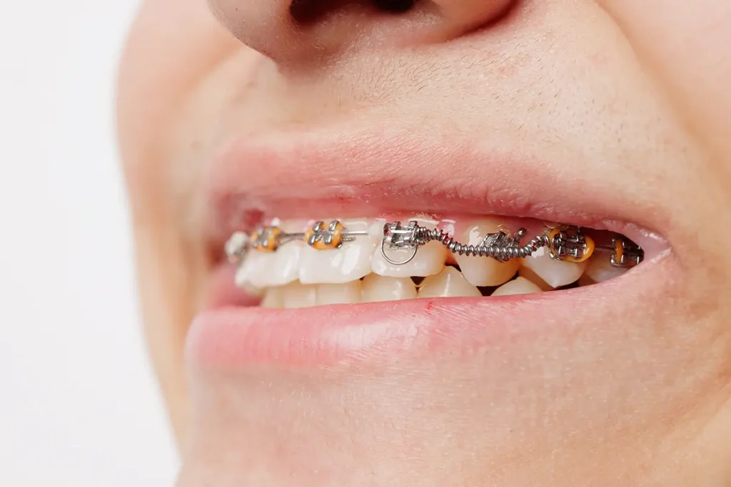 boca sonriendo con brackets