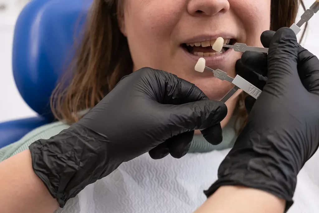 colocación de carillas dentales