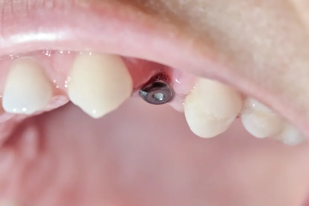 sintomas de la periimplantitis