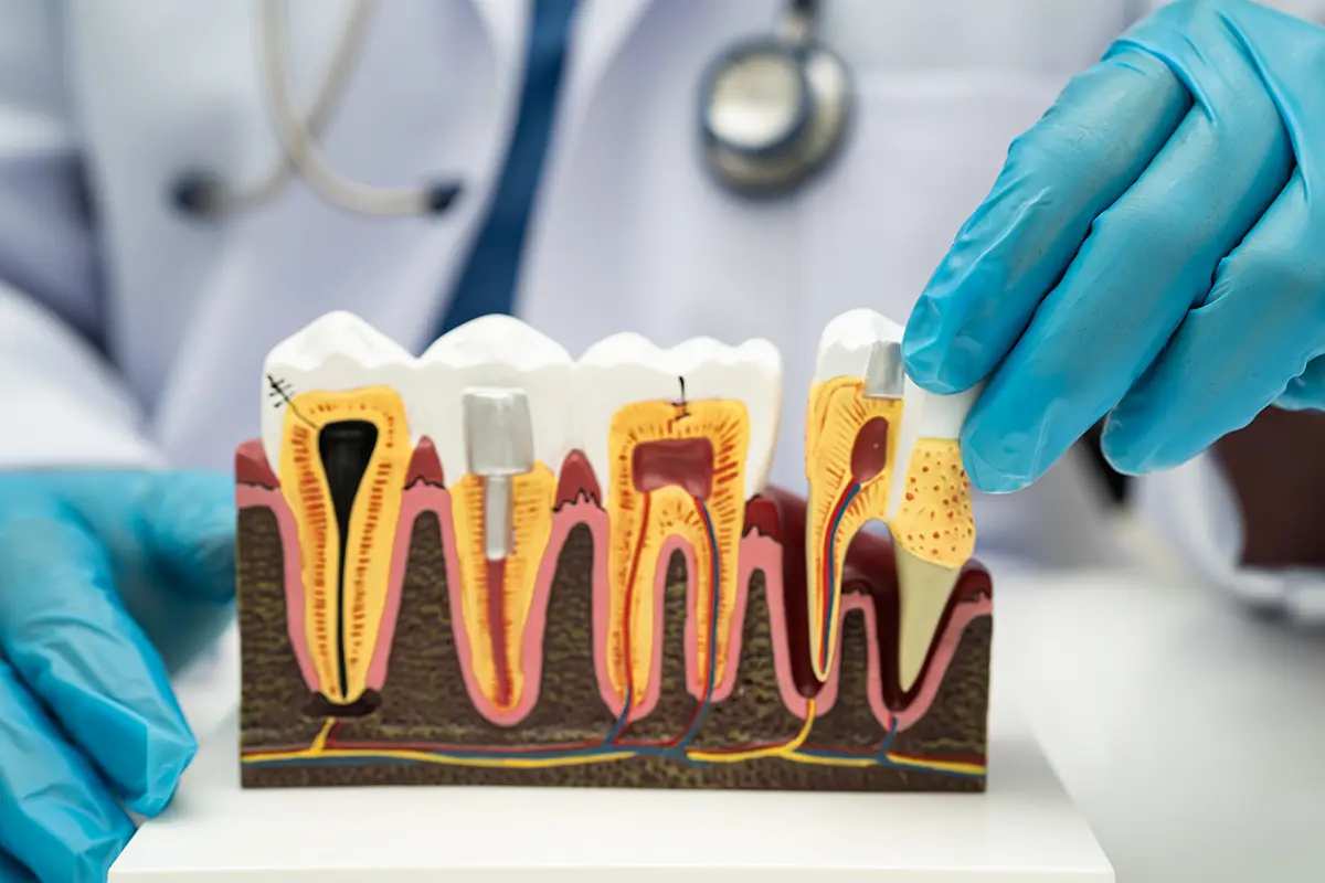 pérdida ósea dental