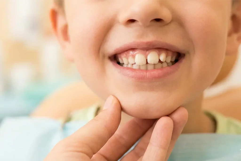 Qué hacer si sale un diente ectópico: qué es y cómo hacerle frente