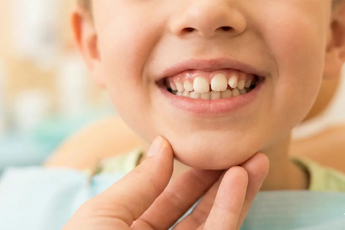 Qué hacer si sale un diente ectópico: qué es y cómo hacerle frente