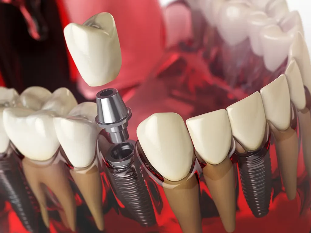 representación 3D de cómo es un implante dental y las partes que lo conforman