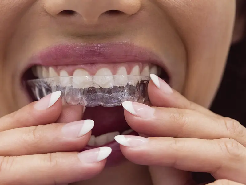 Clínica Bayo Martín, invisalign, ortodoncia invisible en Castro
