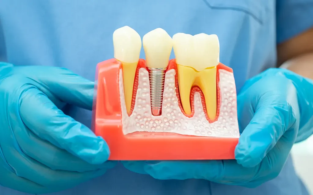 como cuidar los implantes dentales