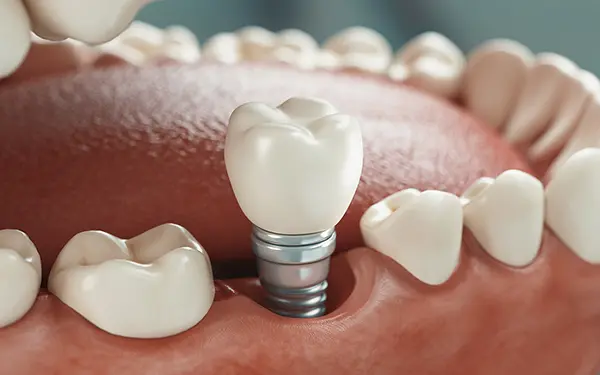 osteointegración implantes dentales