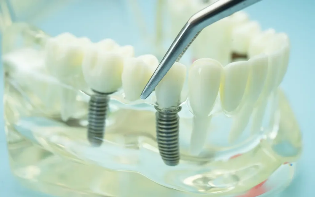periimplantitis