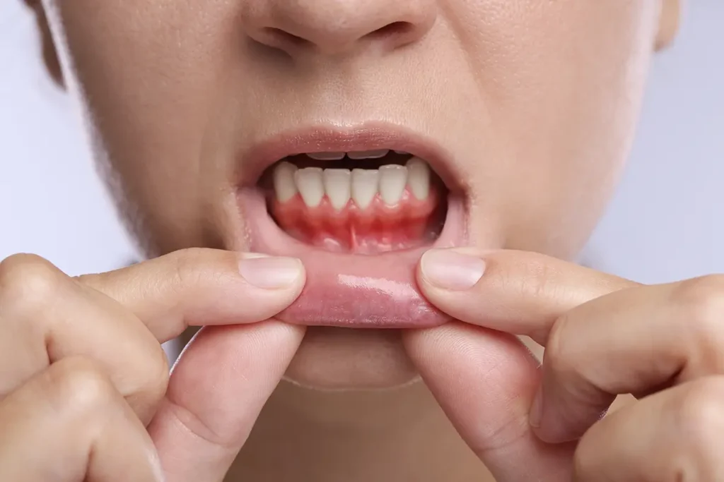 qué dicen los estudios sobre la periodontitis y su relación con el corazón