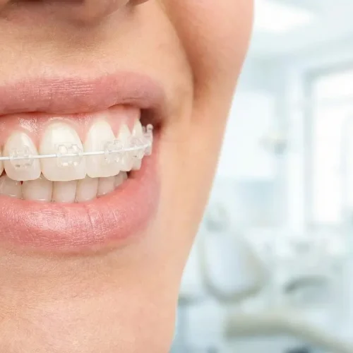 Ventajas sobre los brackets zafiro