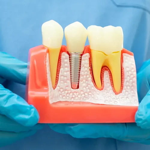 como cuidar los implantes dentales
