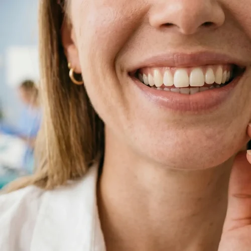 Resultado natural de estética peribucal con ácido hialurónico en la Clínica Dental Bayo Martín de Castro-Urdiales