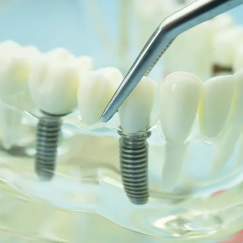 periimplantitis